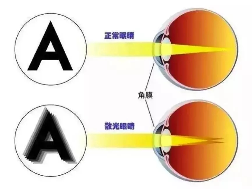 当近视遇上散光就像'火星撞地球'